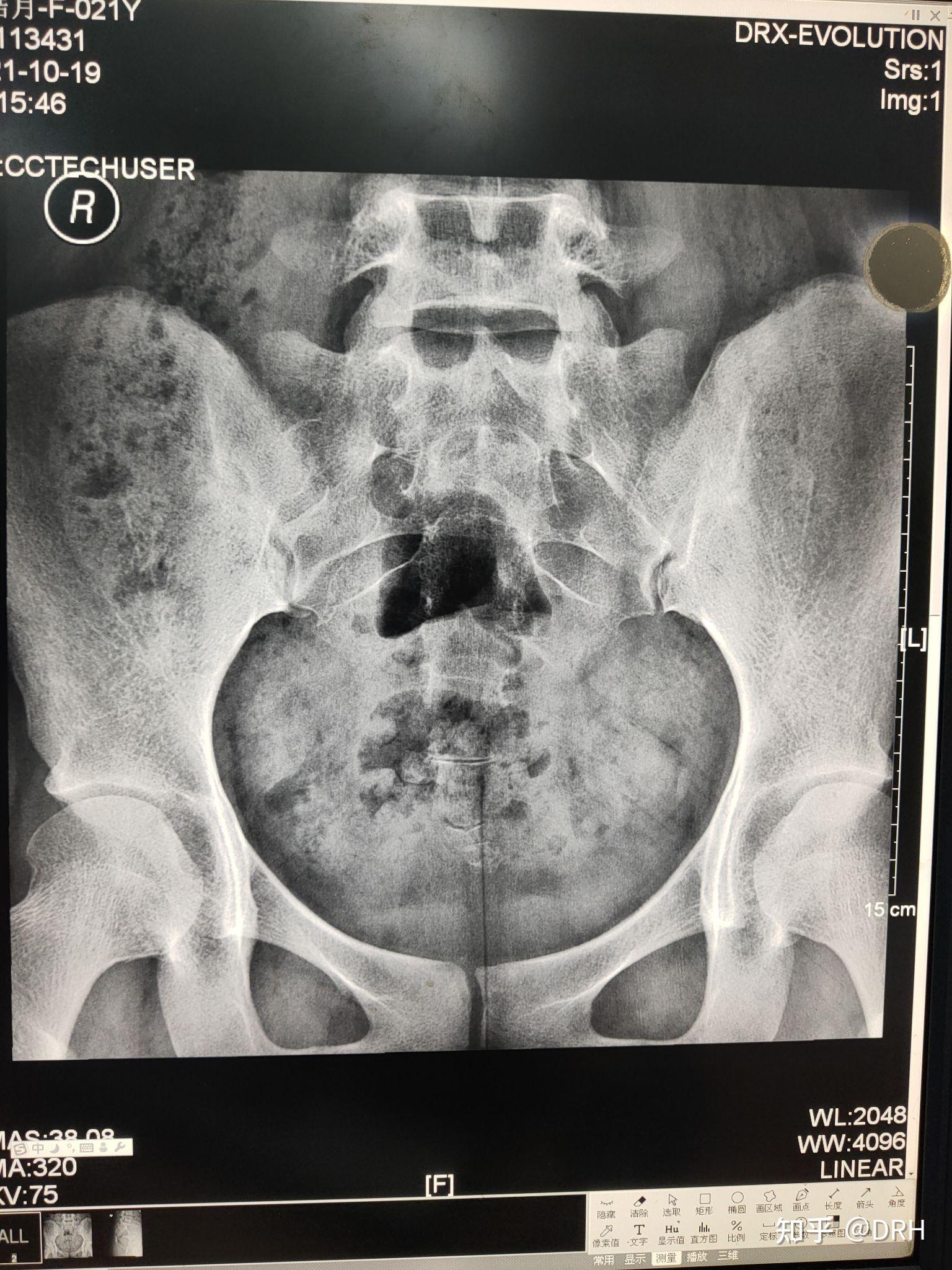 骶尾椎影像报告怎么写? - 知乎