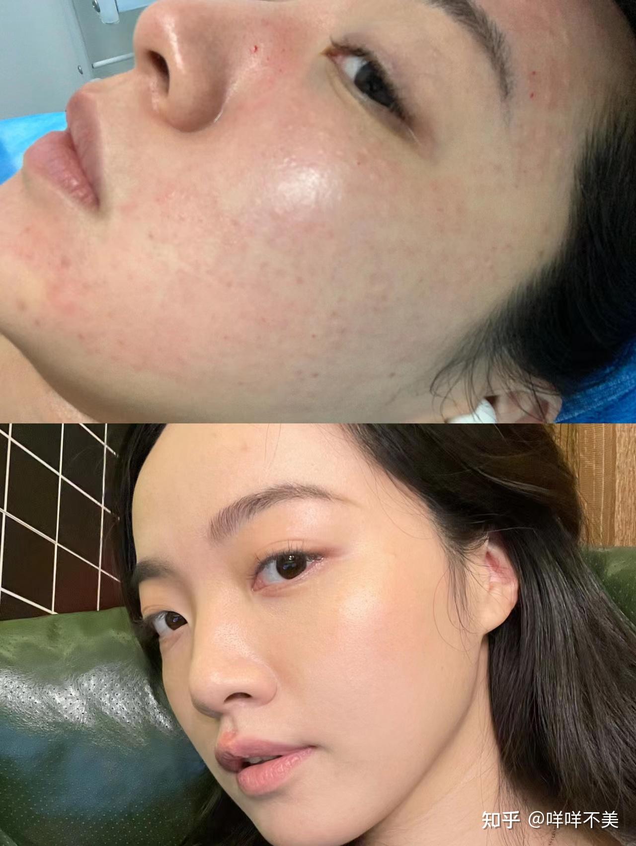 不黑不吹,水光针的效果怎么样? - 知乎