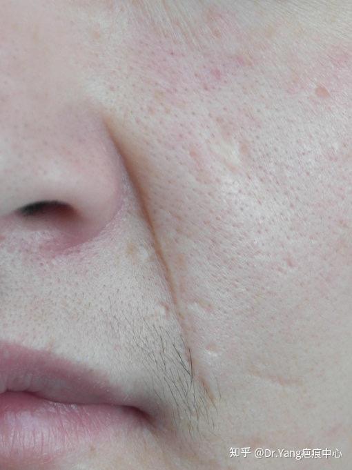 面部色脱疤痕修复术