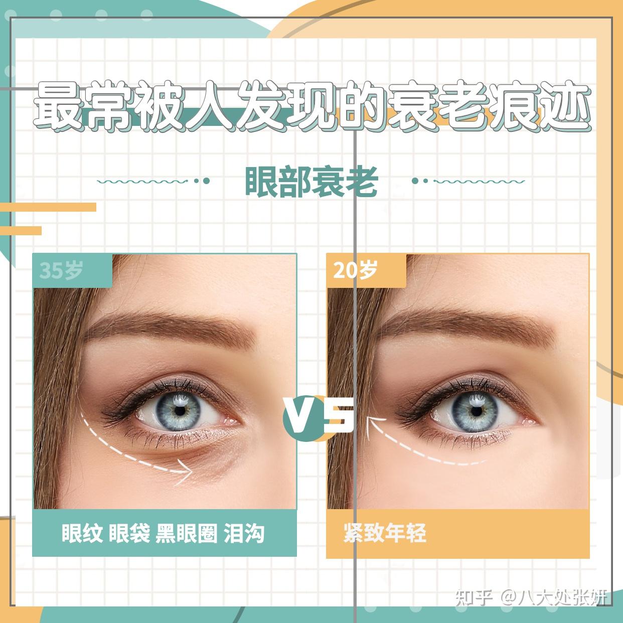 眼周年轻化思路和常用的光电类及手术类方法 - 知乎
