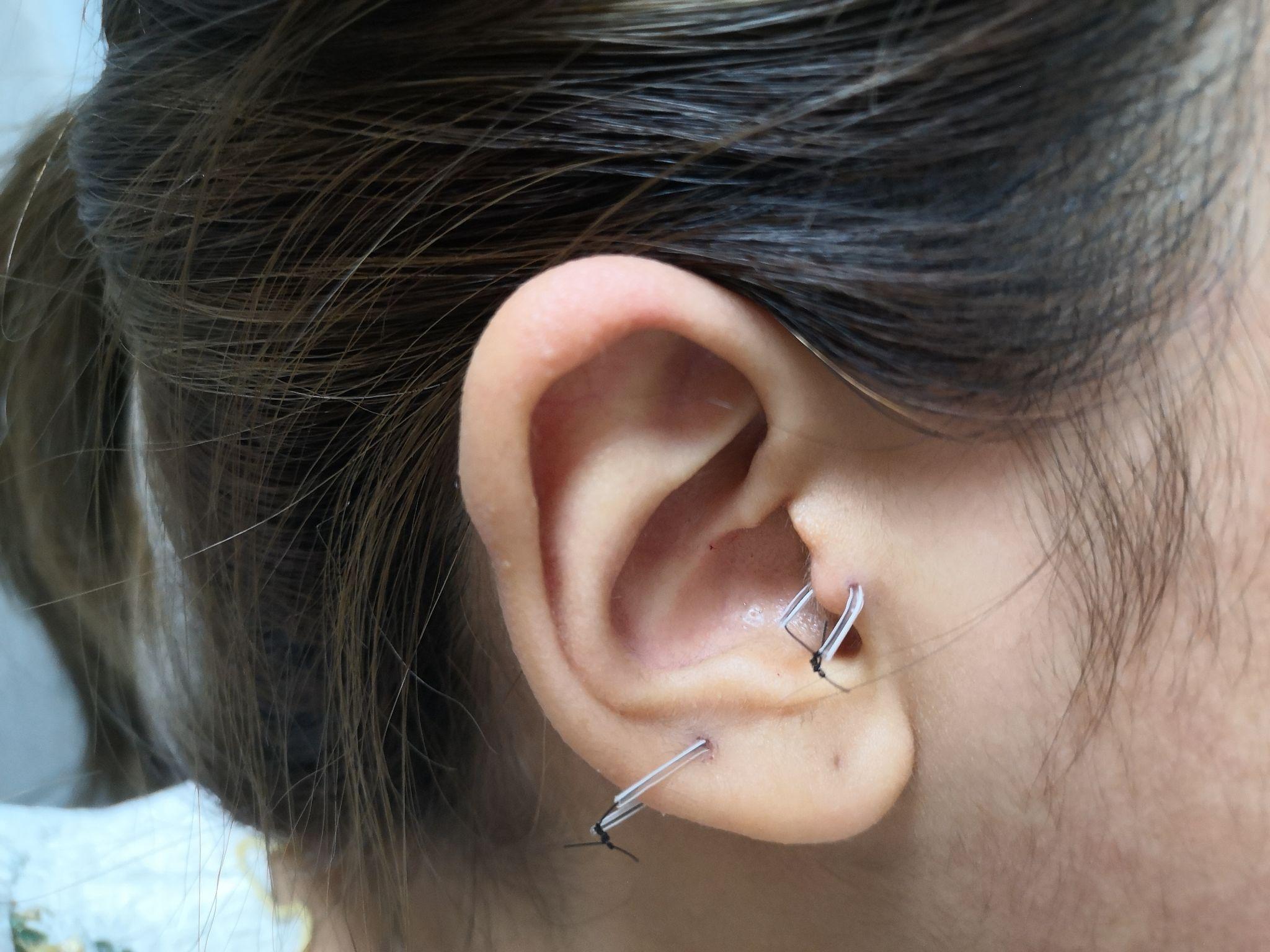 有耳垂的情况下，耳洞打在什么位置好看？