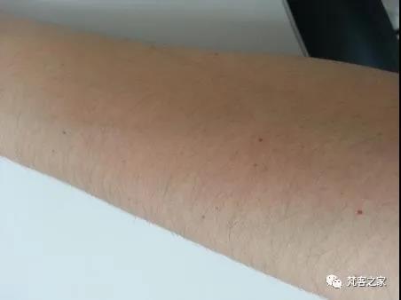 皮肤管理 手臂上有红点是怎么回事 知乎 皮肤管理 手臂上有红点是怎么回事 知乎