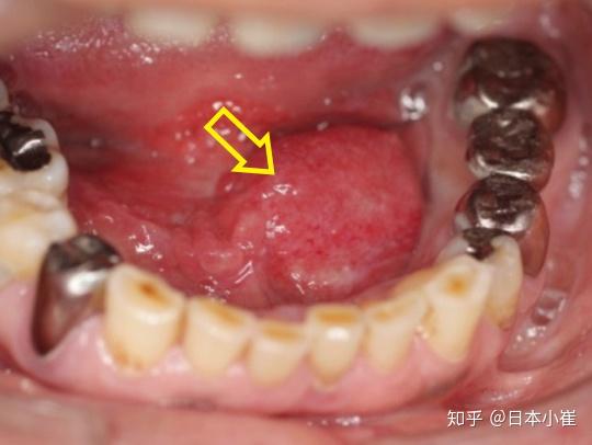 容易被忽视的口腔癌自我检查