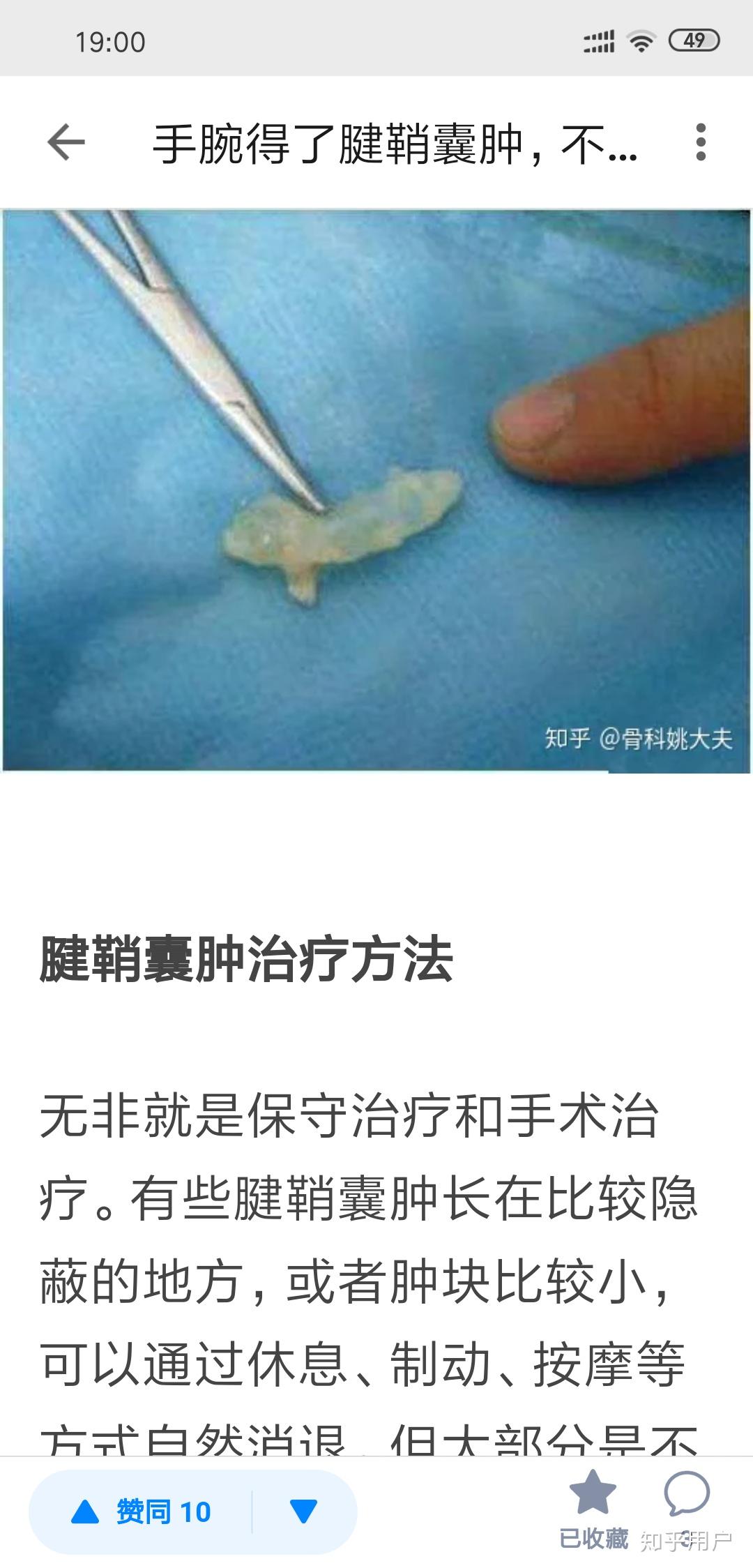 左脚脚背左侧长了个腱鞘囊肿微胀痛该如何治疗