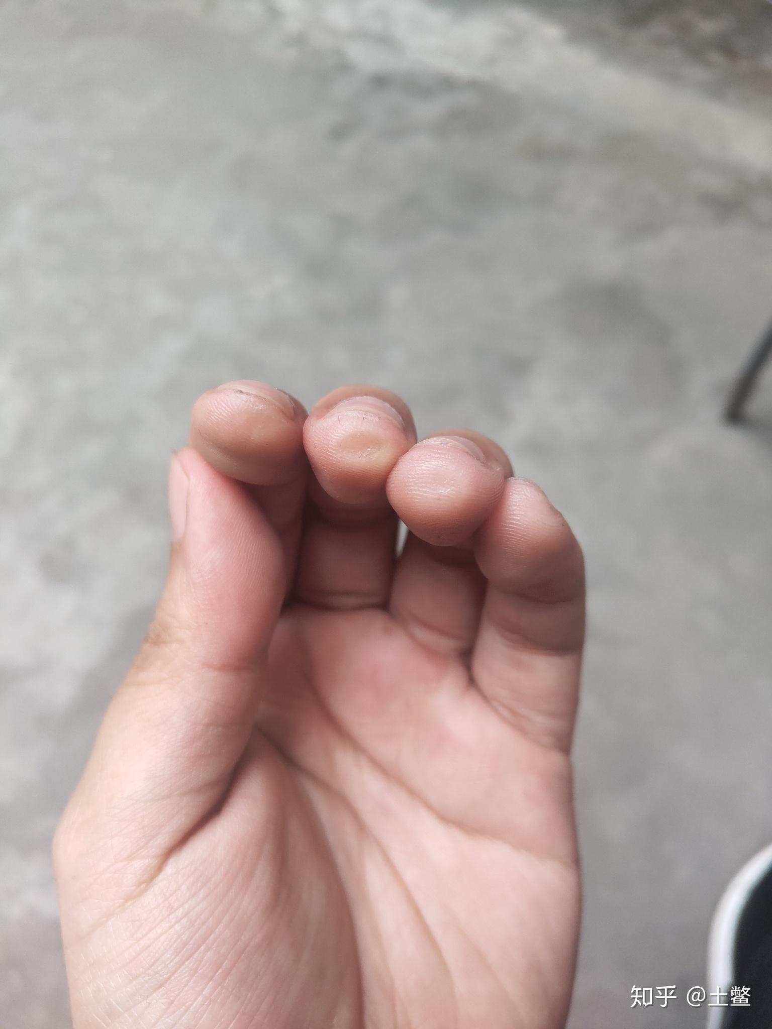 练吉他的时候左手按弦手指尖疼而且爆皮了怎么办? - 知乎