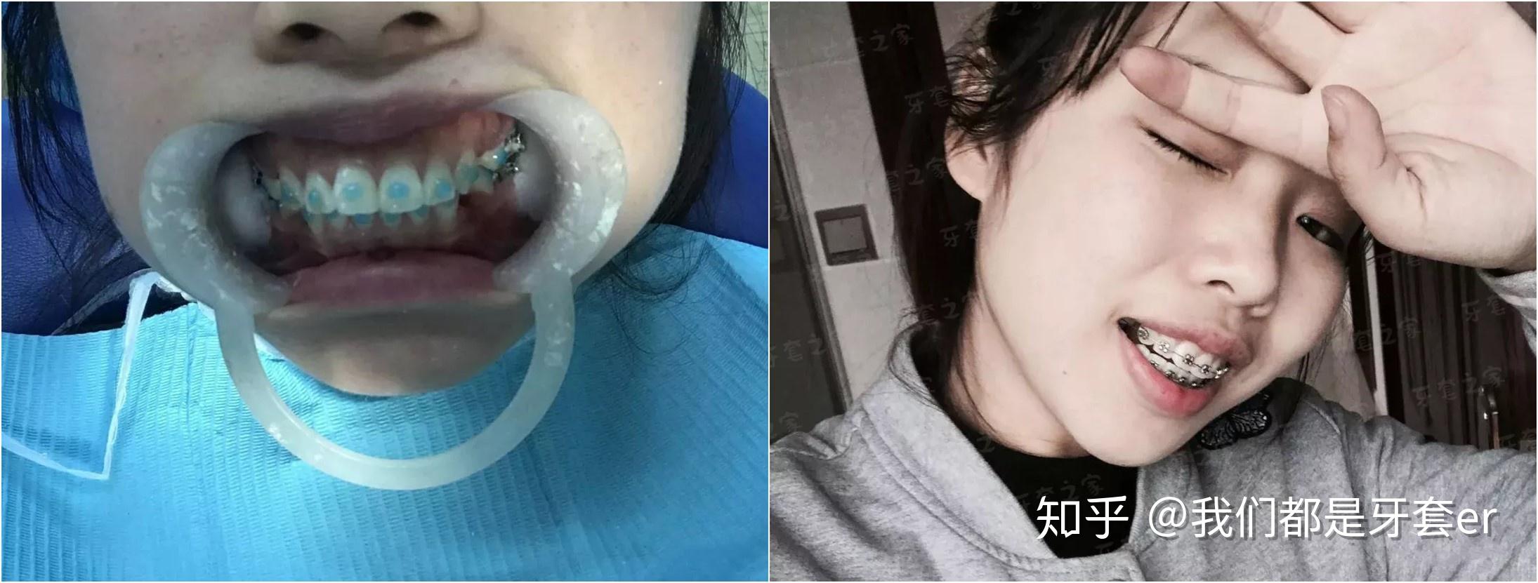 分享 | 93年宝妈,下巴后缩 骨性龅牙,一开始被嘲讽大妈生了娃还折腾