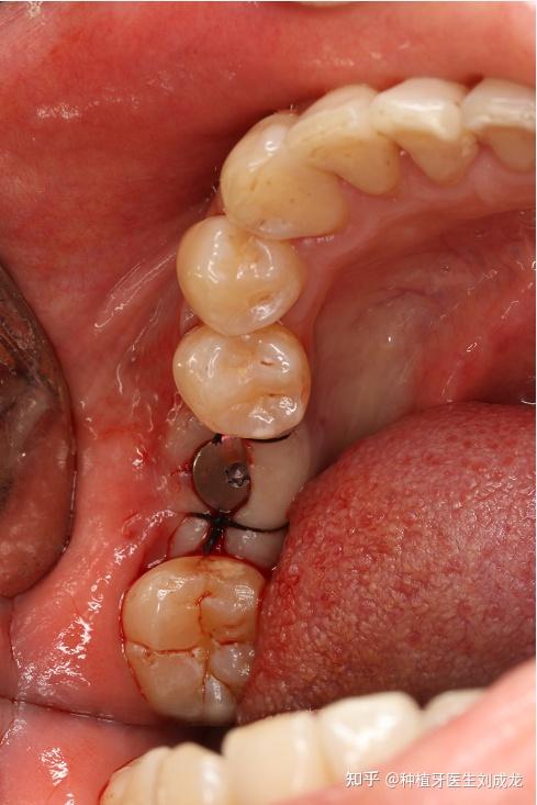 郑州瑞士iti种植牙医生刘成龙41岁女士磨牙区单颗种植案例