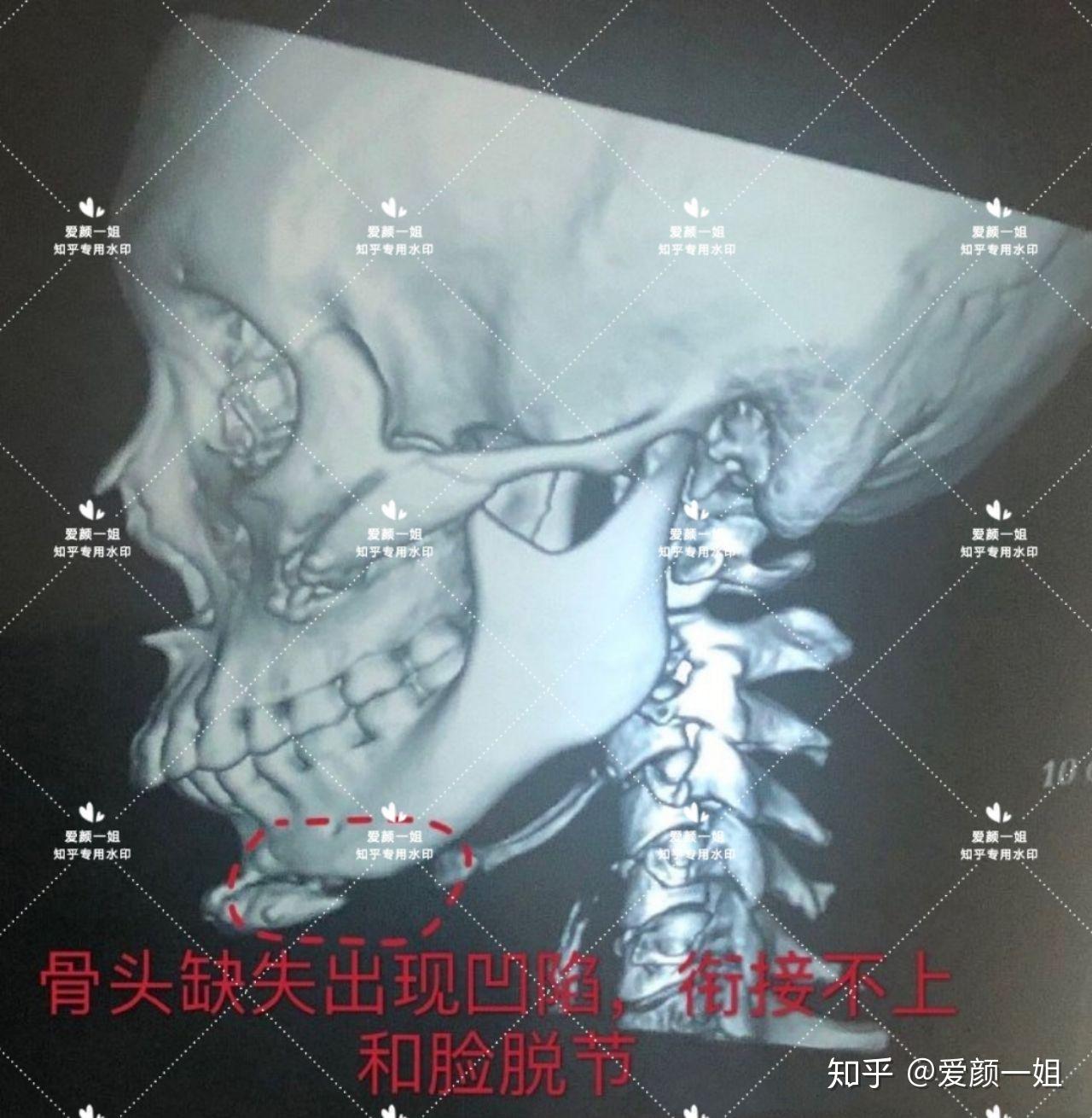 看妹子术后ct,颧骨颧弓内推手术无效果,变化不大,出现明显大小脸;下颌