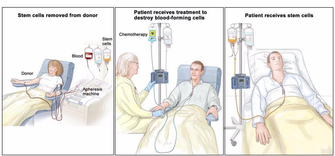 什么是干细胞移植干细胞如何获得移植过程成功率