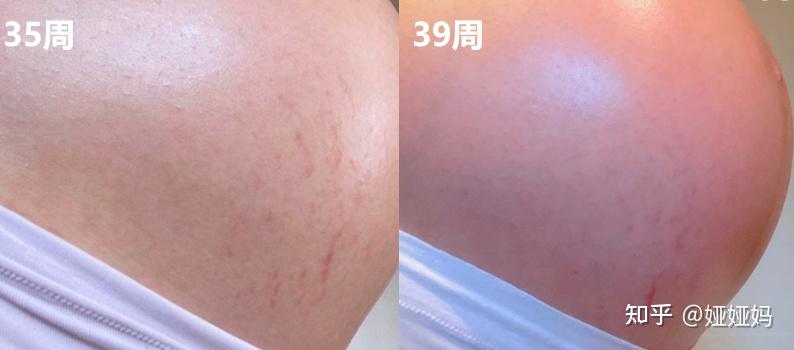 妊娠纹看人下菜这4类人更容易长妊娠纹教你孕期如何预防修复妊娠纹