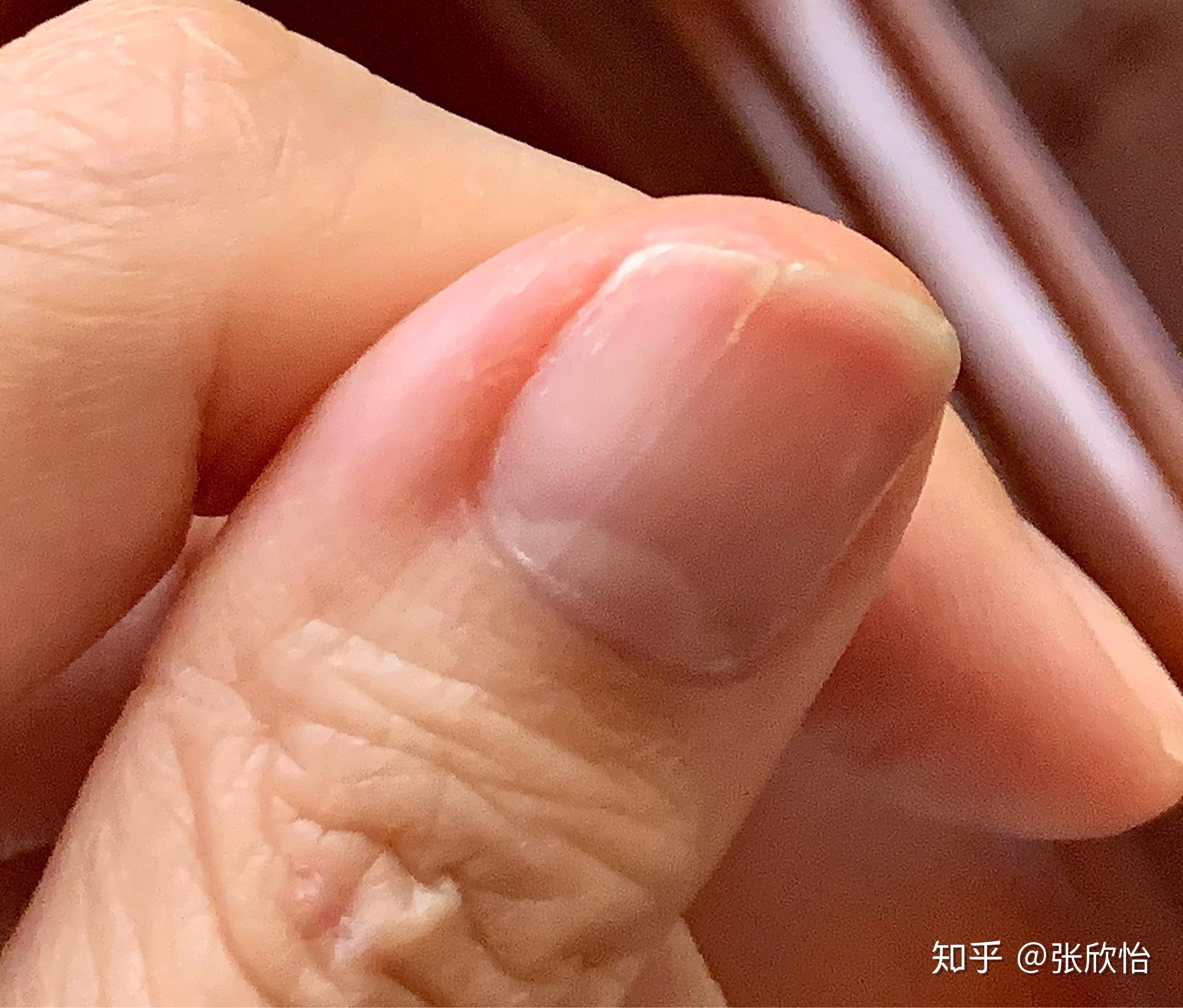 大拇指指甲有白色竖纹5年了今年从竖纹出经常裂开求助