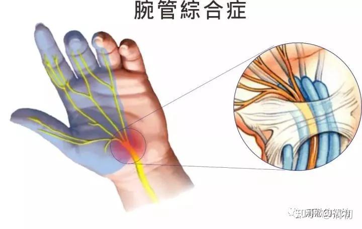 碎碎念之腕管综合征