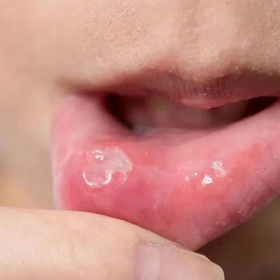 男子口腔溃烂一年未愈查出癌症口腔溃疡有3大特征高度警惕