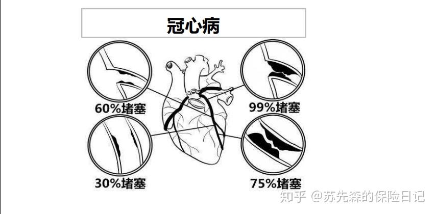 重疾理赔实务之急性心肌梗塞
