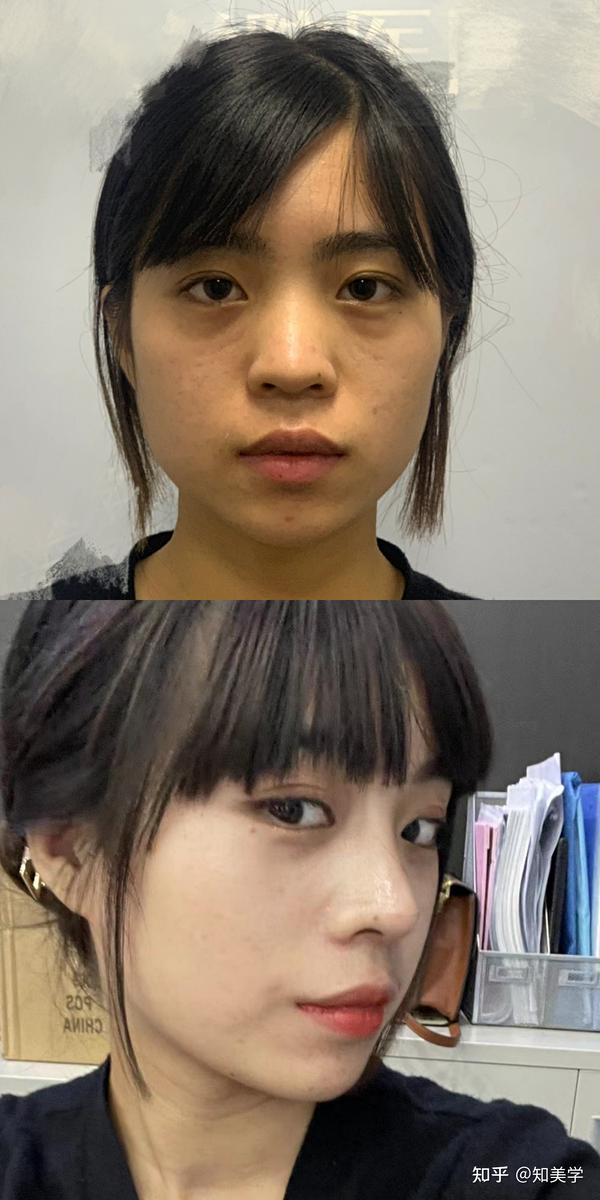 武汉三甲医院隆鼻有推荐吗?