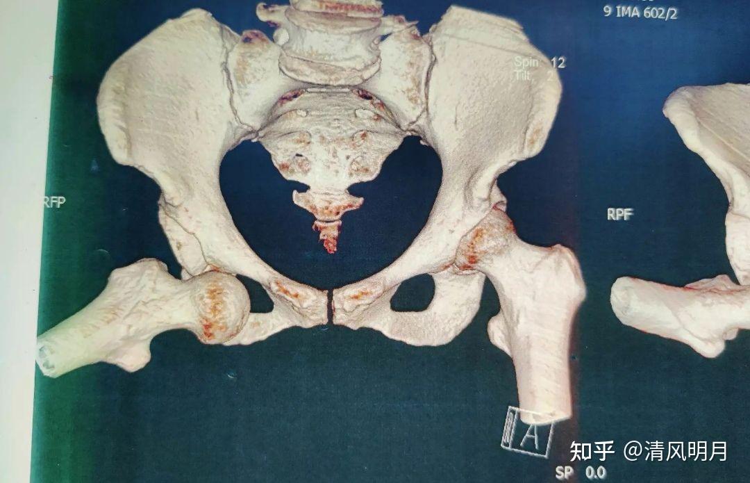 髋关节前脱位的表现症状有哪些?