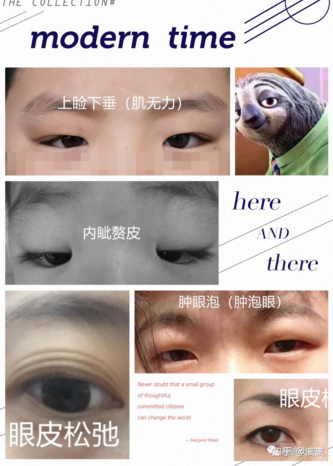眼部专题|整形医生必须了解的眼结膜认知 💋结膜为_圈子-新氧美容整形