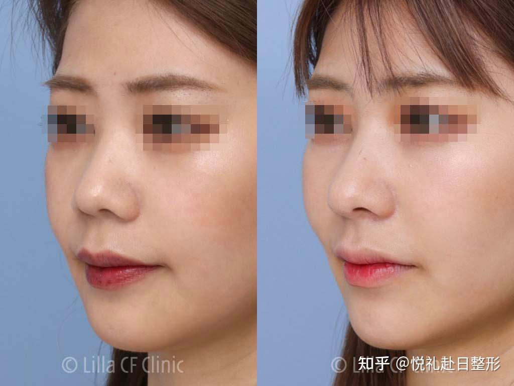 鼻综合只做鼻小柱延长或鼻尖抬高,缩小鼻翼,不做鼻梁假体可以吗?