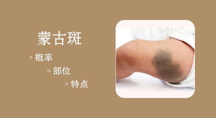 蒙古斑简述