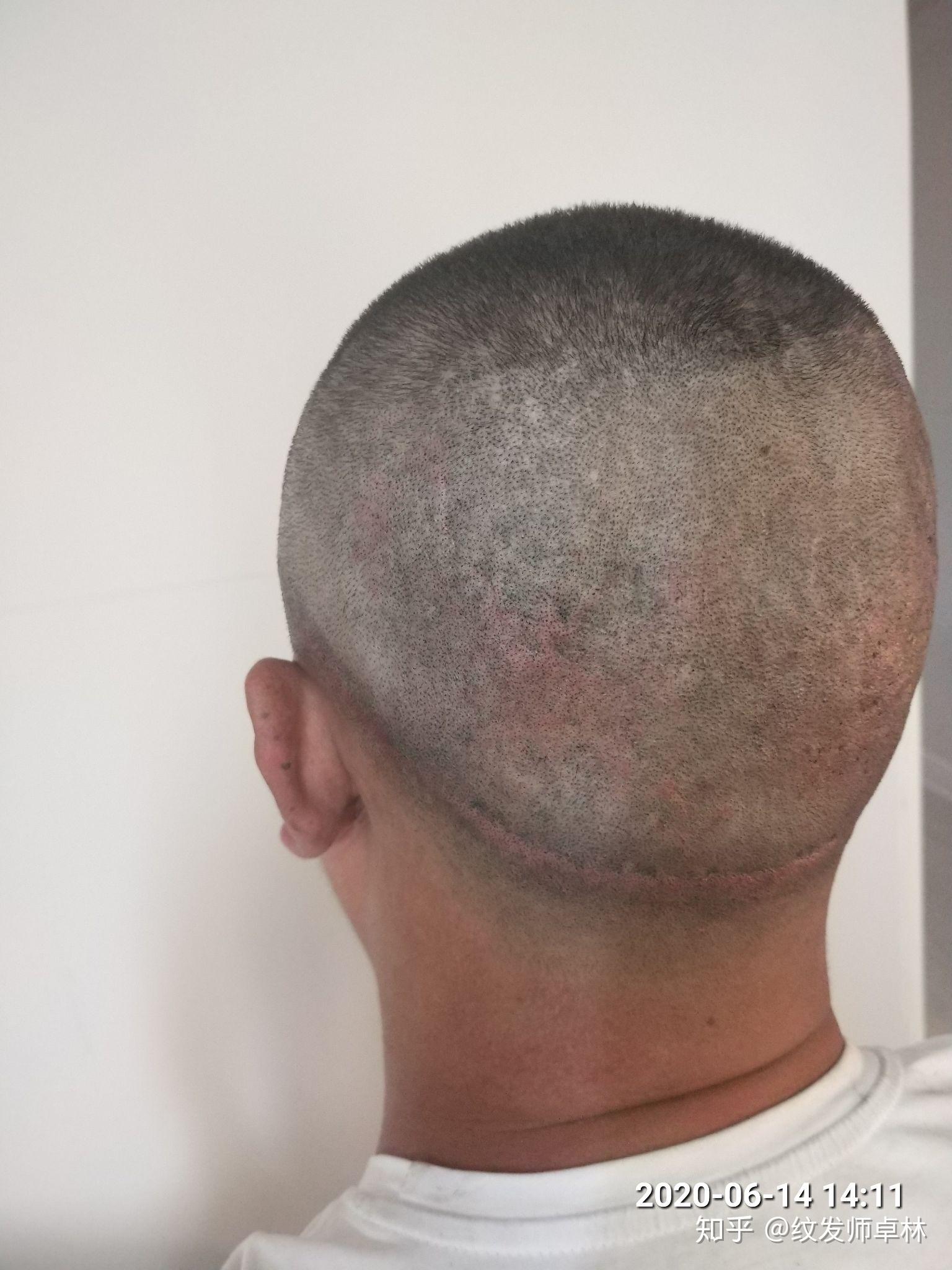 关于头部头皮大面积疤痕,如何以smp纹发技术有效掩盖修饰?