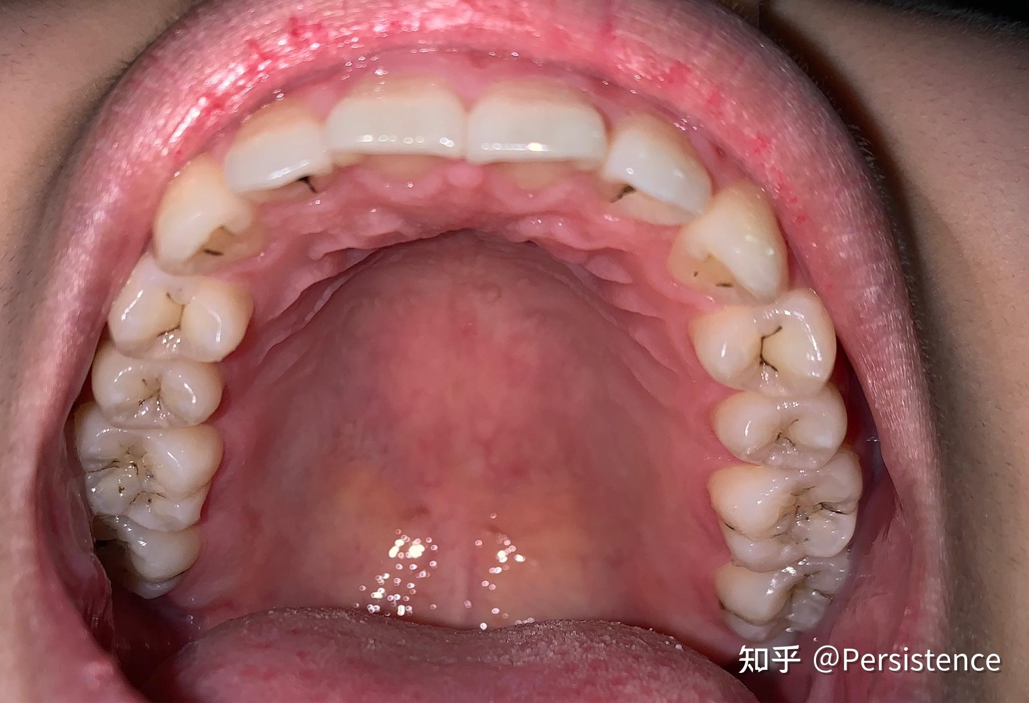 儿童蛀牙的原因是什么？