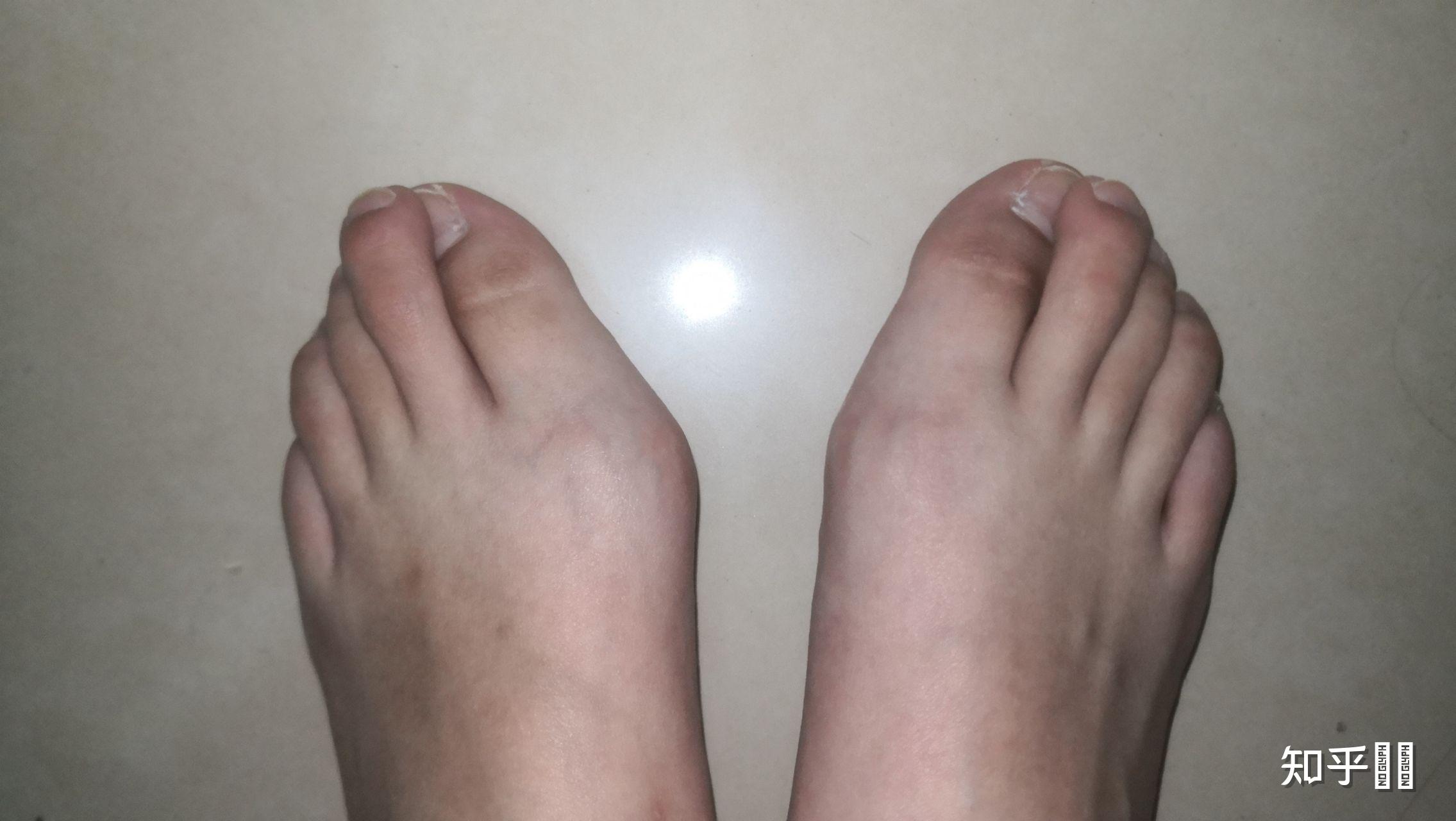女生脚趾拇外翻是什么样体验