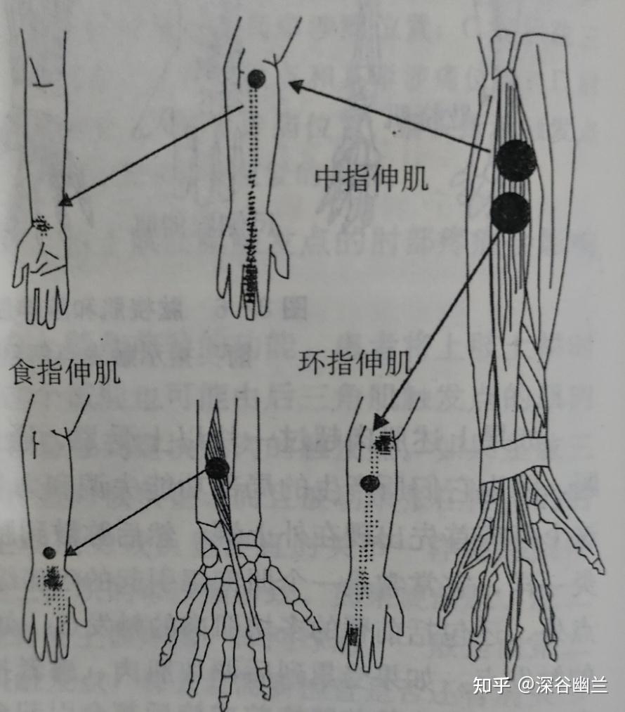 食指伸肌图片