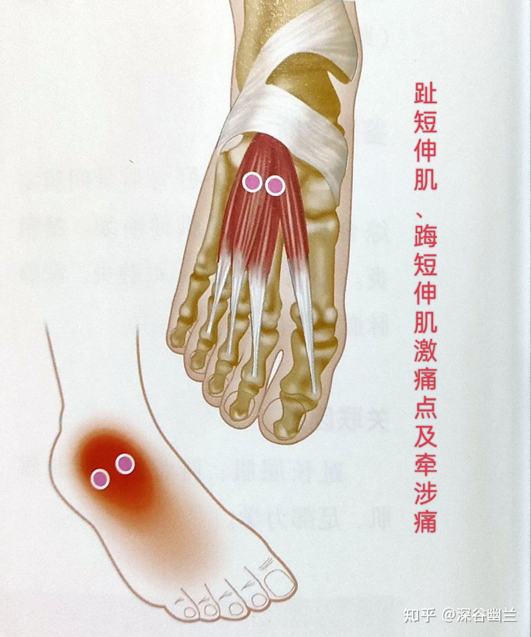 足趾伸肌包括踇短伸肌和趾短伸肌,它们的激痛点牵涉痛在脚背外踝下方4
