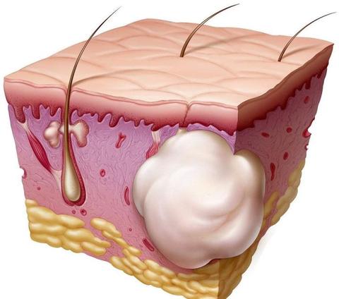 毛囊炎、疖、痈、皮脂腺囊肿怎么区分? - 知乎