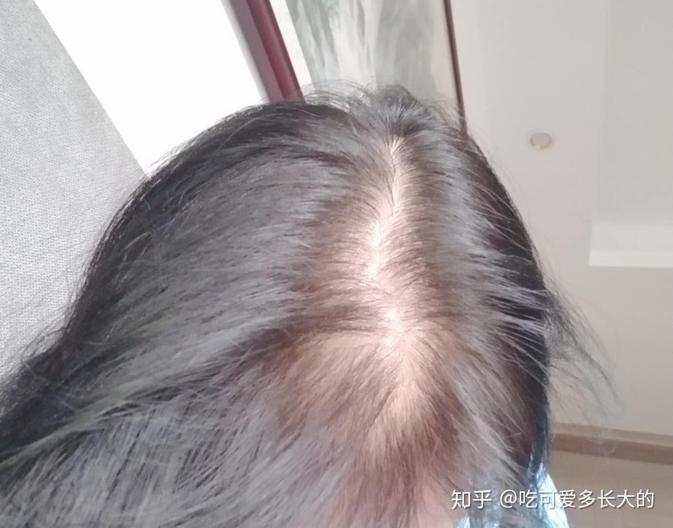 十六岁,这个脱发是几级啊? - 知乎