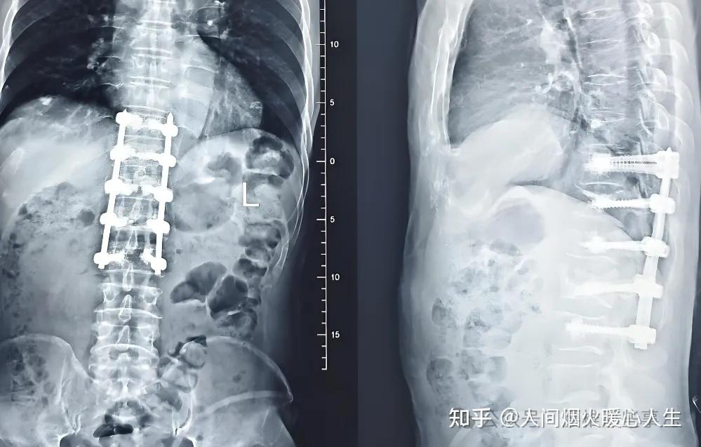 脊髓损伤分级ASIA量表 - 知乎