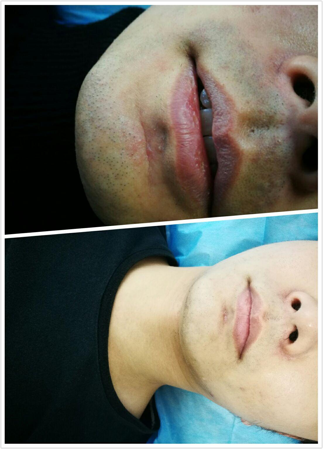 男生胡子太重太密刮完之后还留下很重的胡子黑色印怎么办? - 知乎