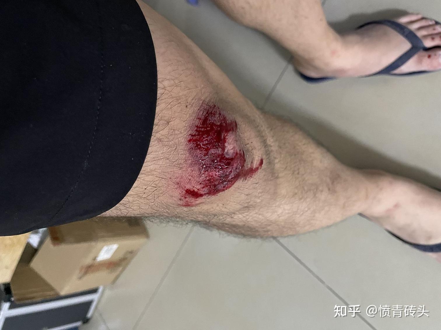 记录一下摔伤后的伤口愈合过程