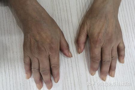 风湿脚痛的常见症状 (风湿 脚疼)