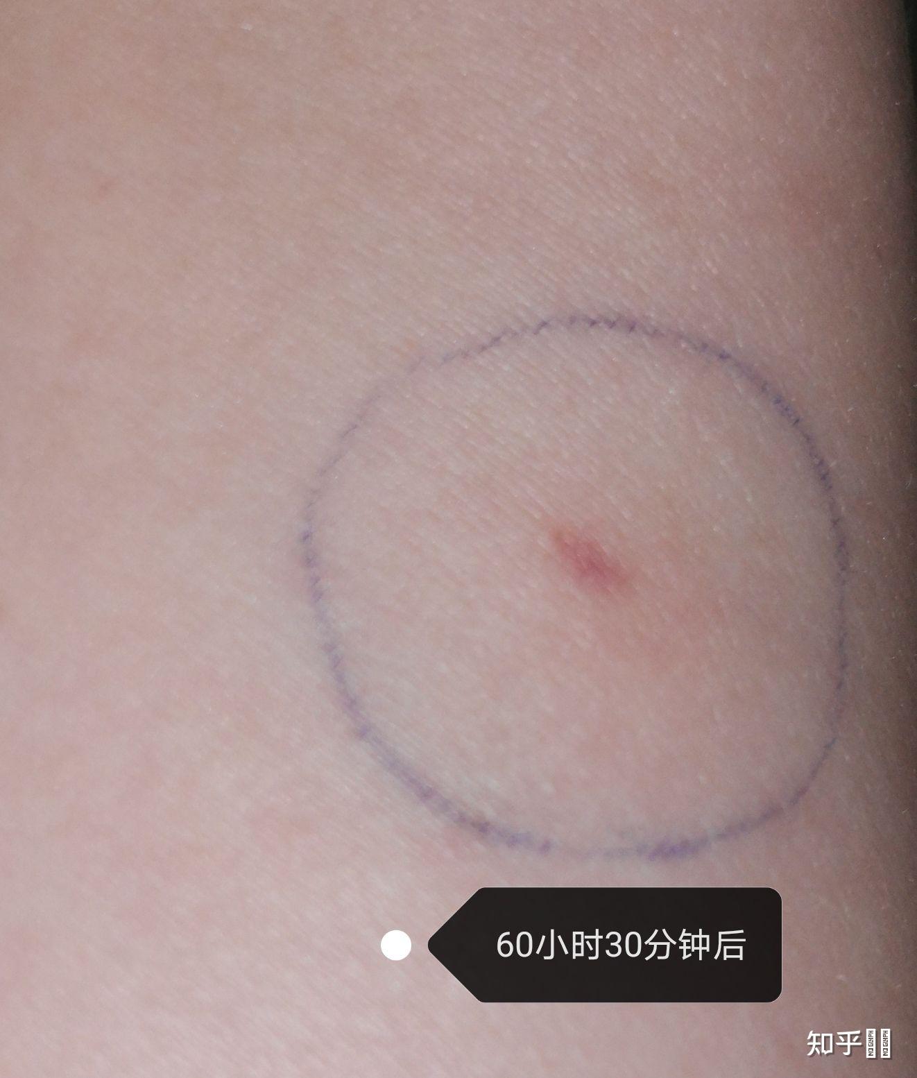 结核皮试出现如下状况,是啥结果呢?