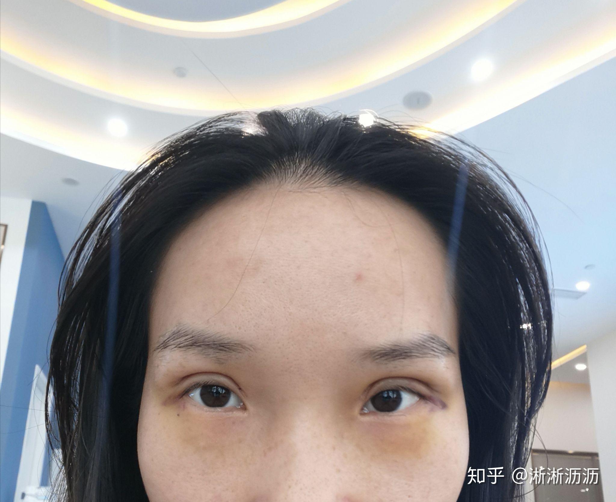 埋线双眼皮感觉埋得很深怎么办