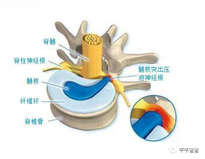 程序员腰突经历分享(中) 程序员腰突经历分享(中)