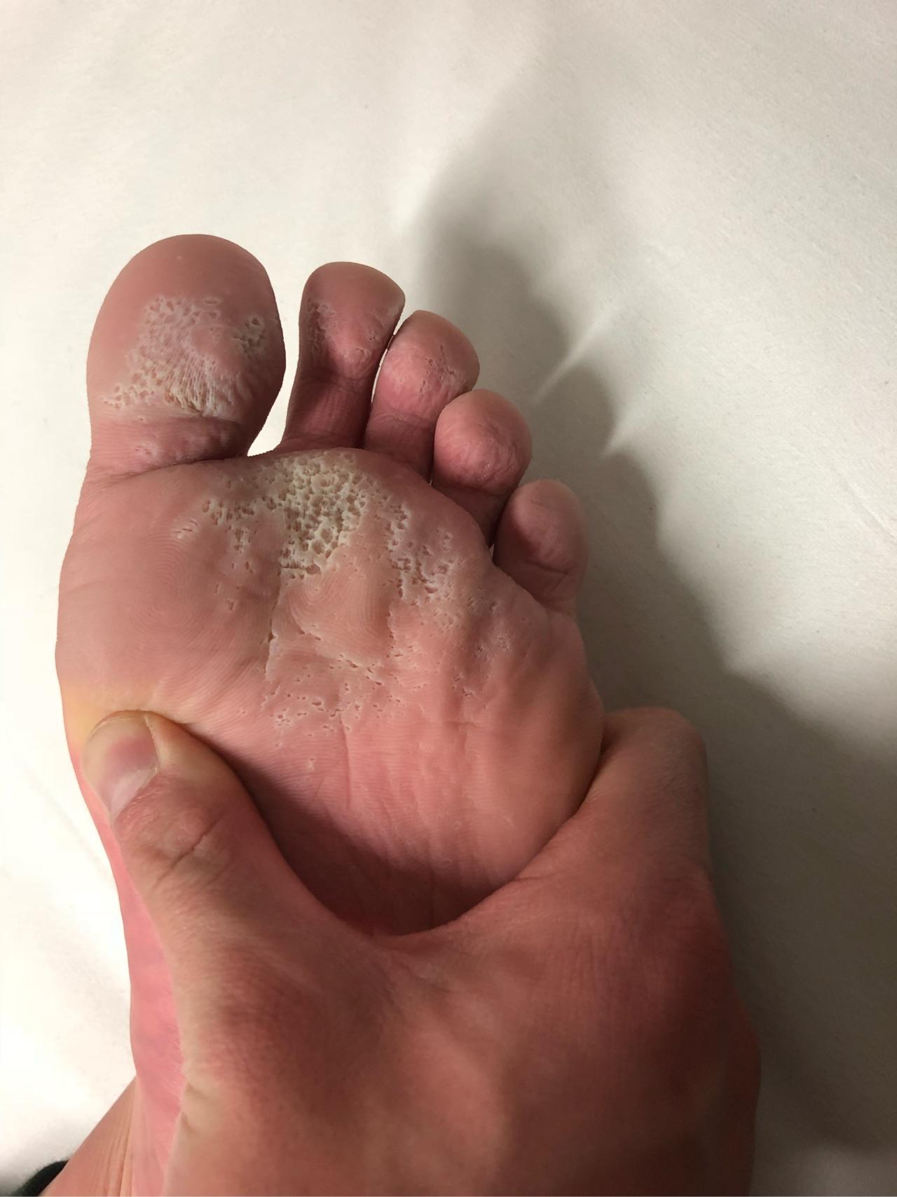 有没有皮肤科的医生帮我看一下脚底下这是什么? - 知乎