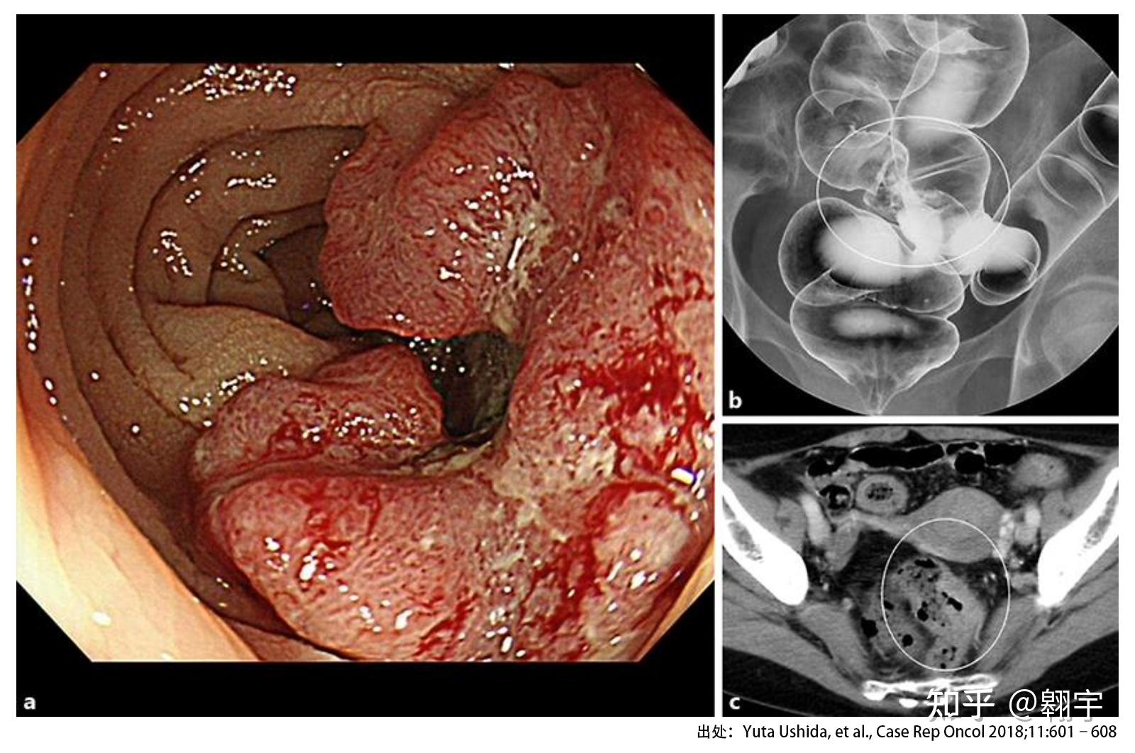 盲肠癌肺转移的跌宕起伏治疗经历