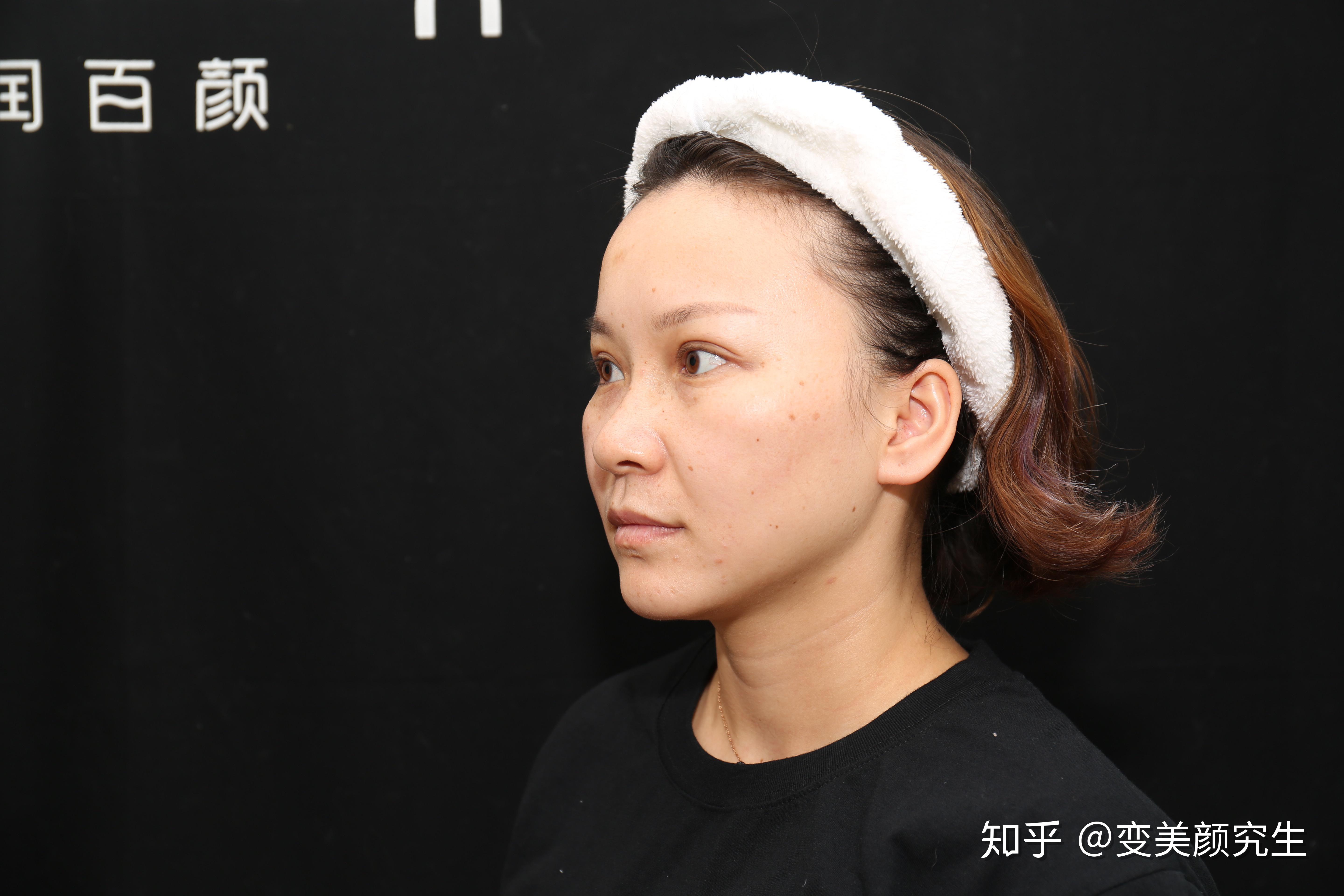 线雕面部提升_面部提升做线雕能维持多久_面部提升线雕视频