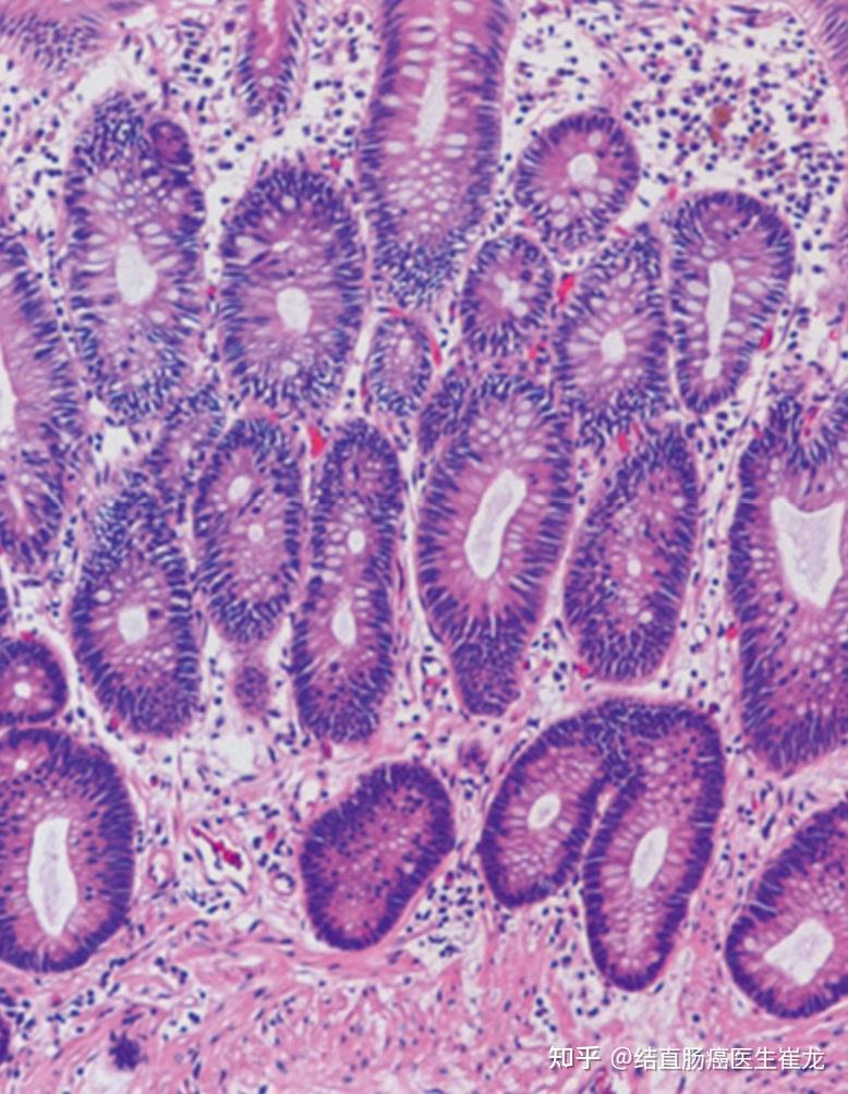 结肠管状腺瘤病理图片图片