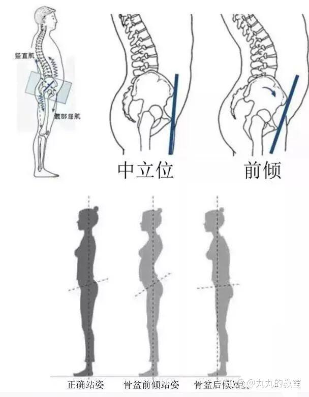 请问这样能判断是骨盆前倾嘛如果不是的话这表明有哪些问题啊