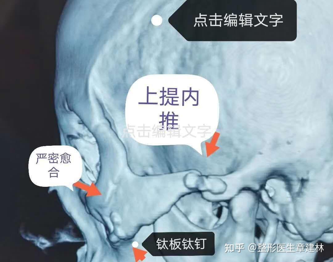 颧弓降低和颧骨内推的区别在哪里,你GET到了吗? - 知乎
