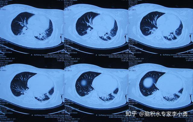 腦血管畸形術後4次腦室外引流致昏迷3種細菌顱內感染間斷高熱2月餘