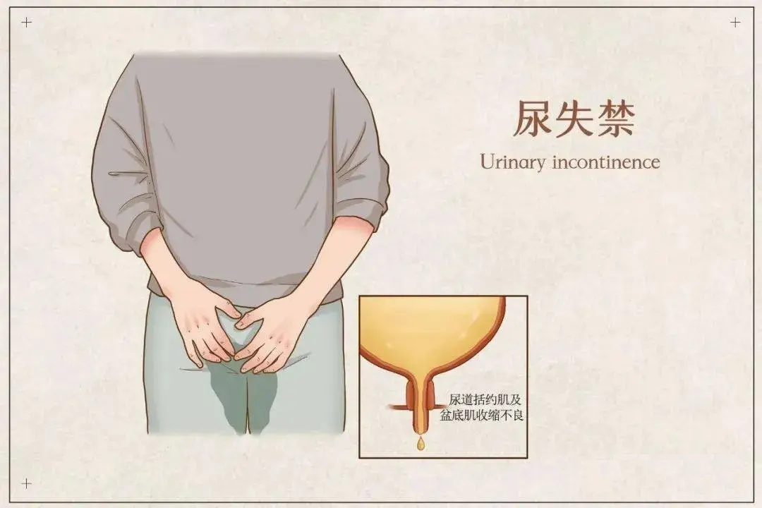 大小便失禁是神经损伤导致的吗? - 知乎