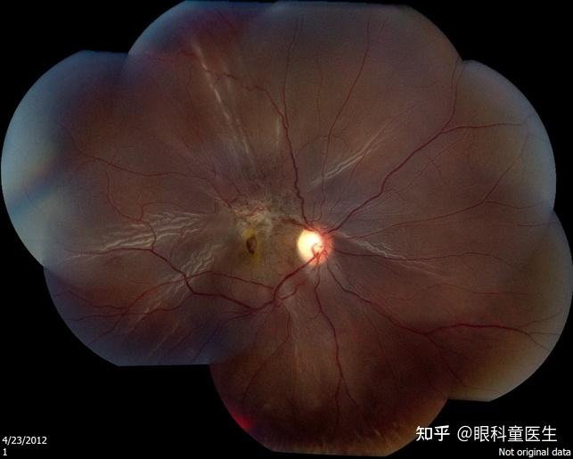 与外伤相关的视网膜病变3外伤性视网膜裂孔和脱离