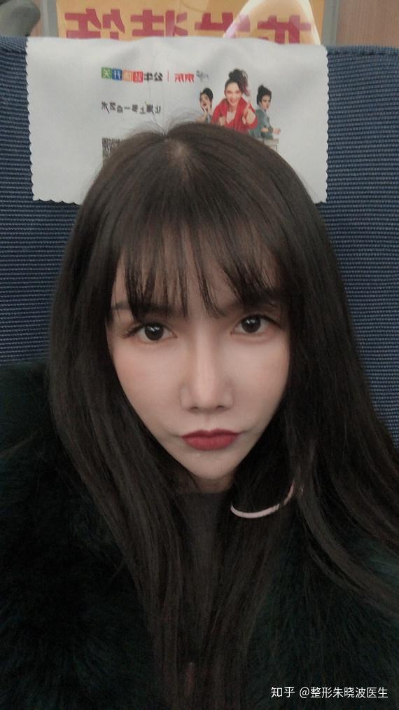 【整形医生朱晓波案例分享】78无辜小鹿眼→眼睑下至 - 知乎