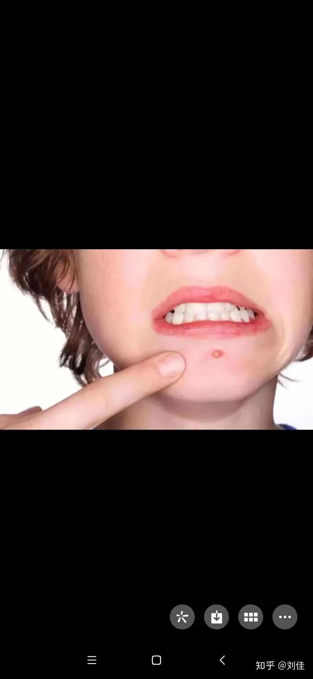 座疮痘痘大揭秘