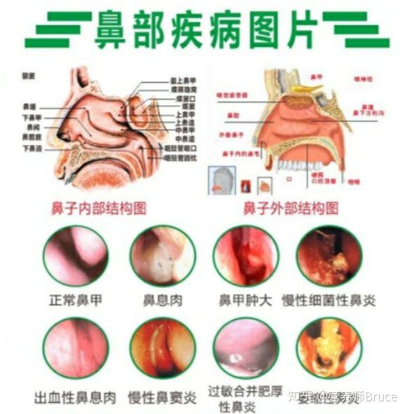 鼻窦炎和正常人的图片图片