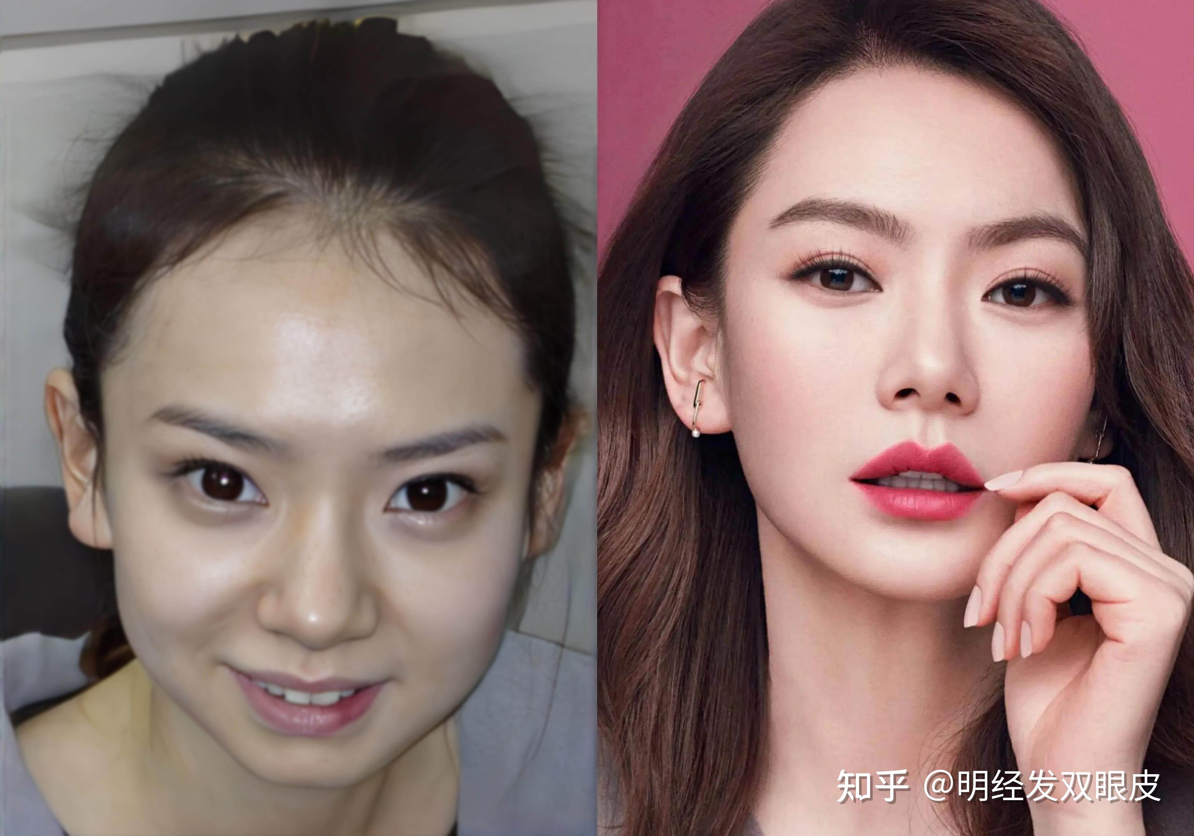 为什么割双眼皮